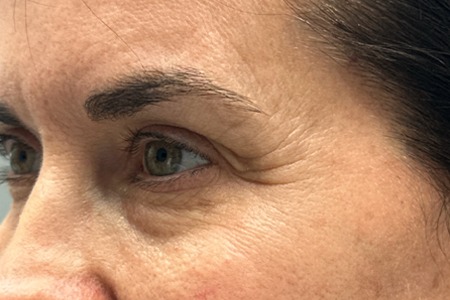 patient 54 before upper bleph with subbrow filler-side.png