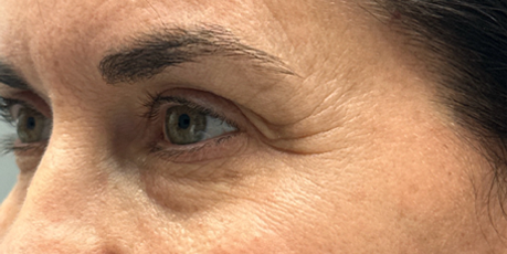 patient 54 before upper bleph with subbrow filler-side.png