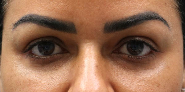 1_0000_patient 1 before lac gland repo.png