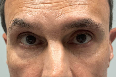 1_0000_patient 13 before subbrow filler .png