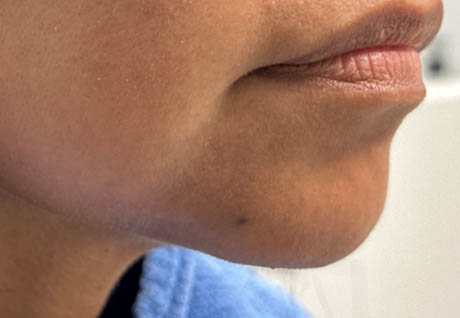 1_0000_patient 3 after chin and jawline filler.PNG