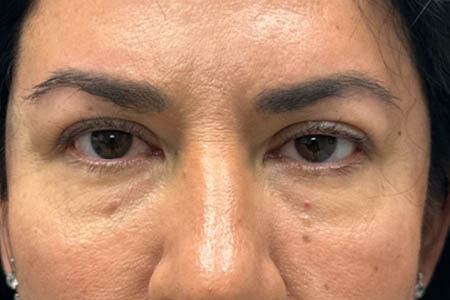1_0000_patient 41 before upper bleph with subbrow filler.png