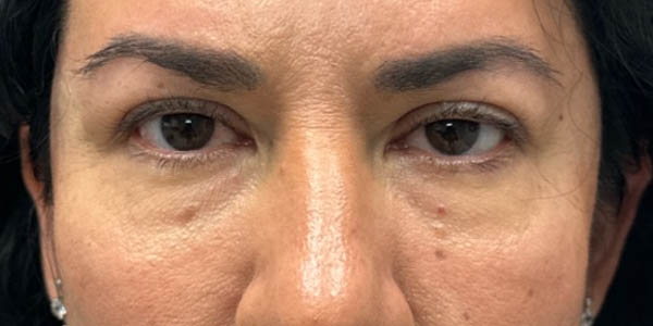 1_0000_patient 41 before upper bleph with subbrow filler.png