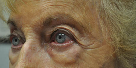 1_0000_patient 8 before lower bleph.PNG