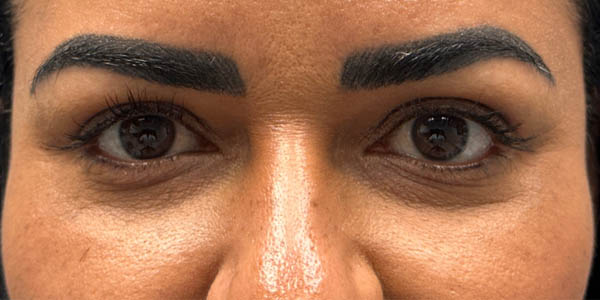 1_0001_patient 1 after lac gland repo.png