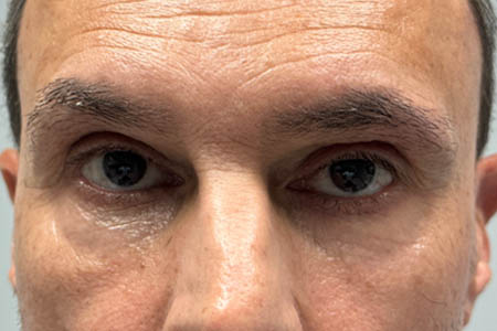 1_0001_patient 13 after subbrow filler .png