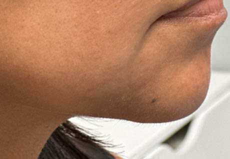 1_0001_patient 3 before chin and jawline filler.PNG