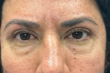 1_0001_patient 41 after upper bleph with subbrow filler.png