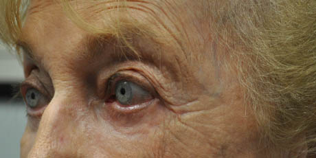 1_0001_patient 8 after lower bleph.PNG