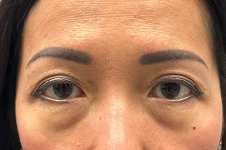 1_0002_patient 14 before subbrow filler.png