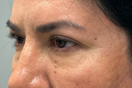 1_0002_patient 41 before upper bleph with subbrow filler– left side.png