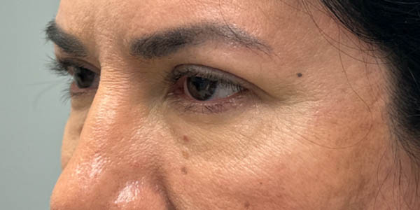 1_0002_patient 41 before upper bleph with subbrow filler– left side.png