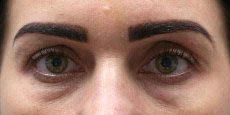 1_0002_patient 9 before lower bleph with facial fat grafting.jpg