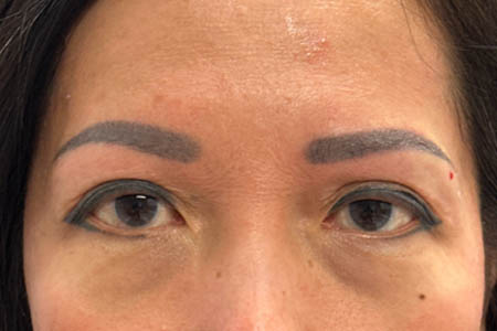 1_0003_patient 14 after subbrow filler.png
