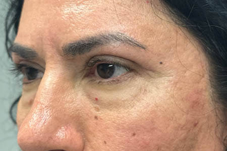 1_0003_patient 41 after upper bleph with subbrow filler– left side.png