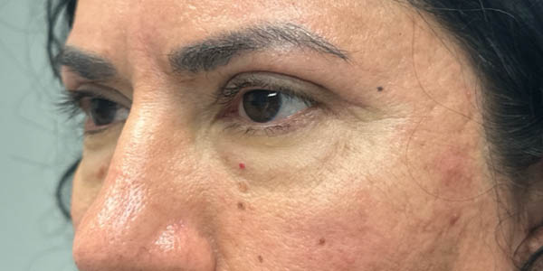 1_0003_patient 41 after upper bleph with subbrow filler– left side.png
