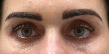 1_0003_patient 9 after lower bleph with facial fat grafting.jpg