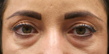 1_0004_patient 10 before lower bleph with facial fat grafting.jpg