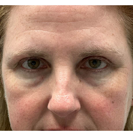 1_0004_patient 11 before cheek filler.png