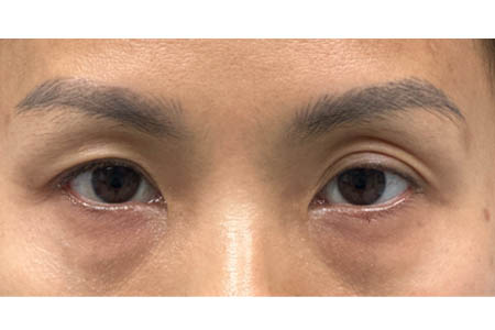 1_0004_patient 15 before subbrow filler- front.png