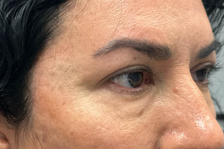 1_0004_patient 41 before upper bleph with subbrow filler– right side.png