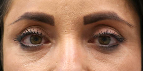 1_0005_patient 10 after lower bleph with facial fat grafting.jpg