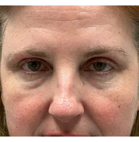 1_0005_patient 11 after cheek filler.png