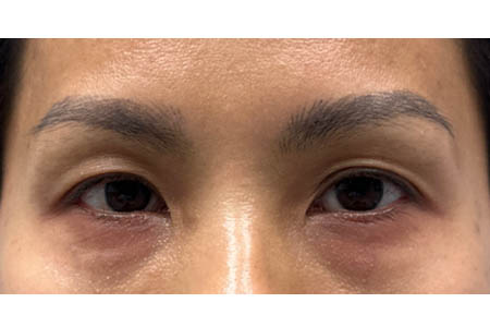 1_0005_patient 15 after subbrow filler- front.png