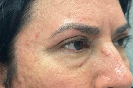 1_0005_patient 41 after upper bleph with subbrow filler– right side.png