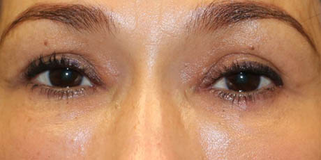 1_0006_PT7-Upper Before Eyes (2).JPG