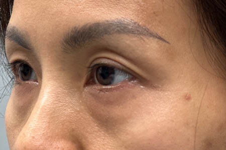 1_0006_patient 15 before subbrow filler- side.png