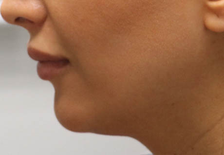 1_0006_patient 6 before chin and jawline filler.PNG