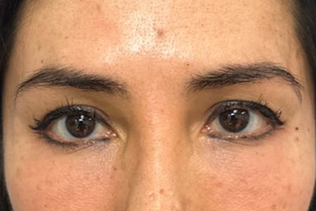 1_0006_pt 99 before upper blep with subbrow filler.png