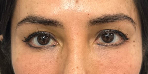 1_0006_pt 99 before upper blep with subbrow filler.png