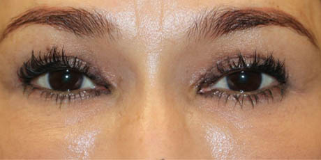 1_0007_PT7-After Upper Eyes (2).JPG