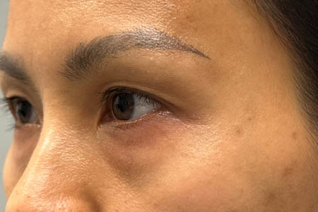 1_0007_patient 15 after subbrow filler- side.png