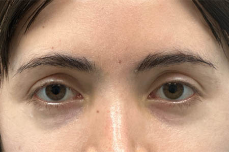 1_0008_patient 16 before subbrow filler.png