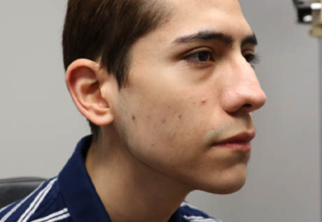 1_0008_patient 7 after chin and jawline filler.PNG