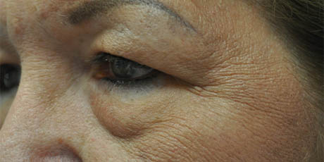 1_0008_patient 7 before upper bleph (side) (1).PNG