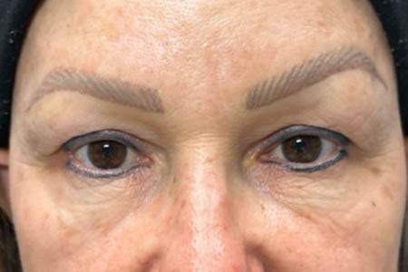 1_0008_pt 105 before upper blep with subbrow filler.png