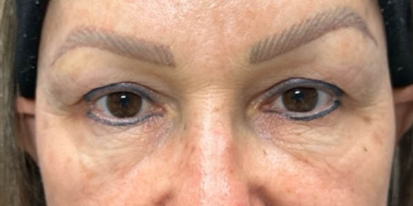 1_0008_pt 105 before upper blep with subbrow filler.png