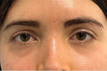 1_0009_patient 16 after subbrow filler.png