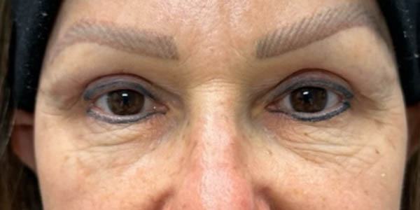 1_0009_pt 105 after upper blep with subbrow filler.png