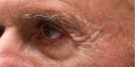 1_0010_patient 2 before direct brow lift (front).PNG