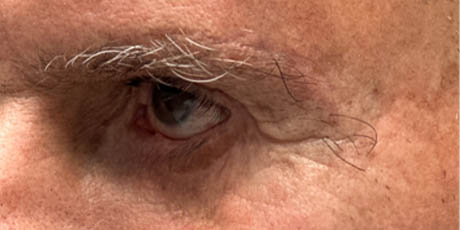 1_0011_patient 2 after direct brow lift (front).PNG