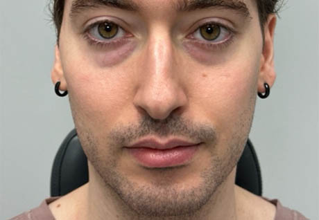 1_0012_patient 14 before chin filler- front.png