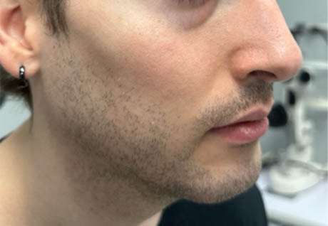 1_0017_patient 14 after chin filler- right side.png