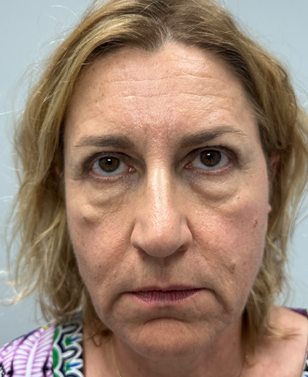 BY BONNIE patient 15 after dissolving under eye filler.png