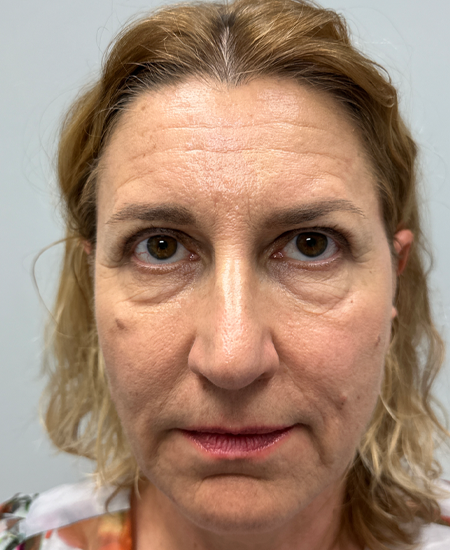 BY BONNIE patient 15 before dissolving under eye filler.png