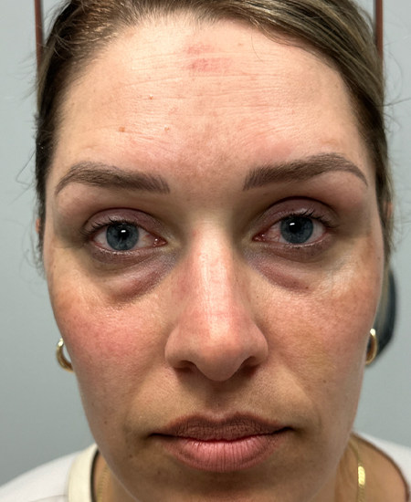 BY BONNIE patient 16 after dissolving under eye filler.png